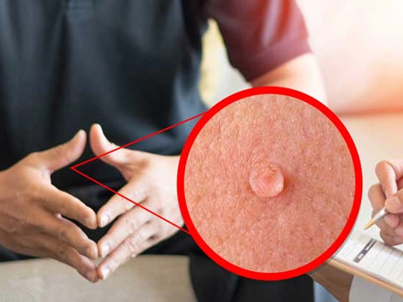 عوارض زگیل تناسلی